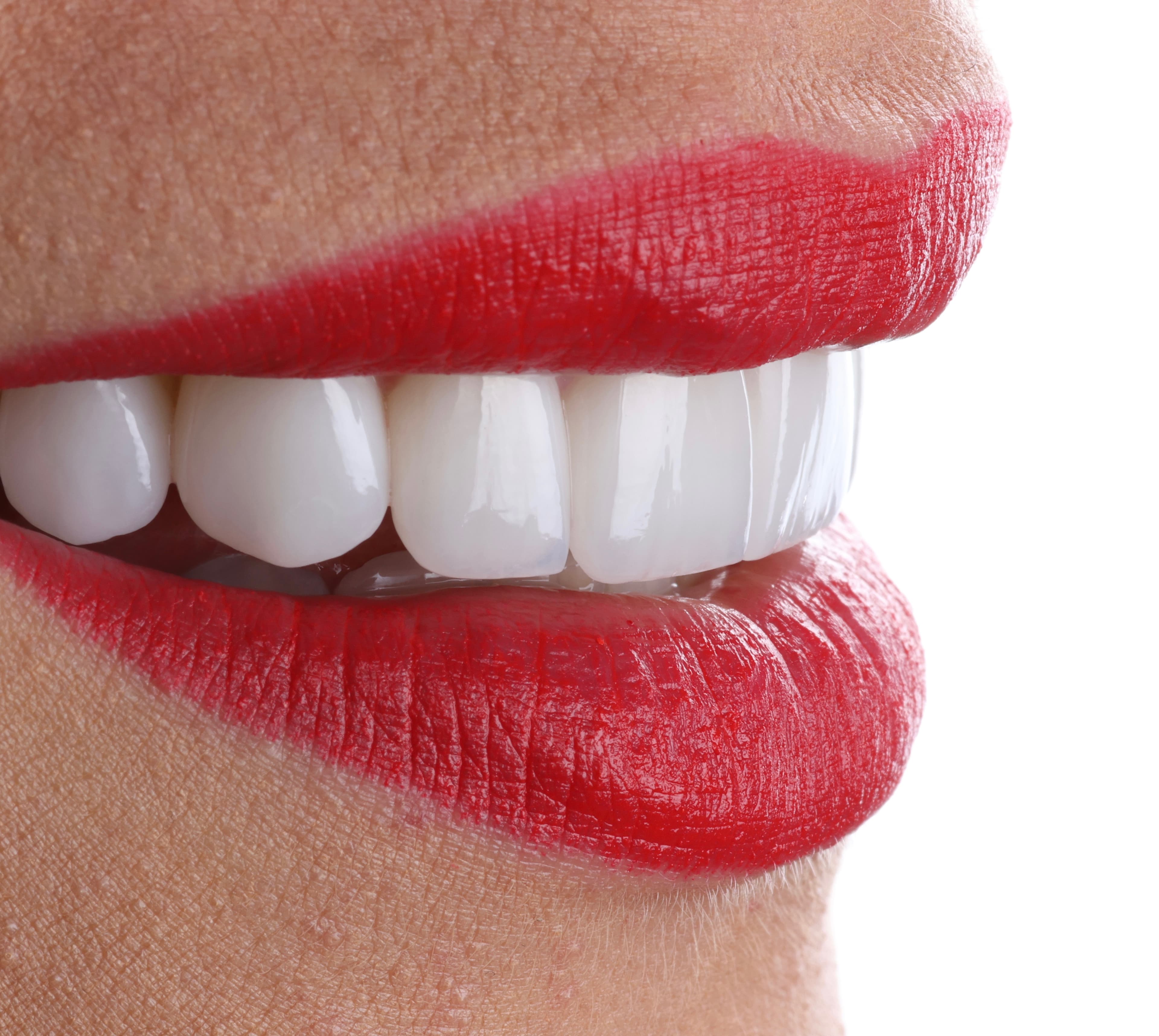 Porcelain veneers before and after