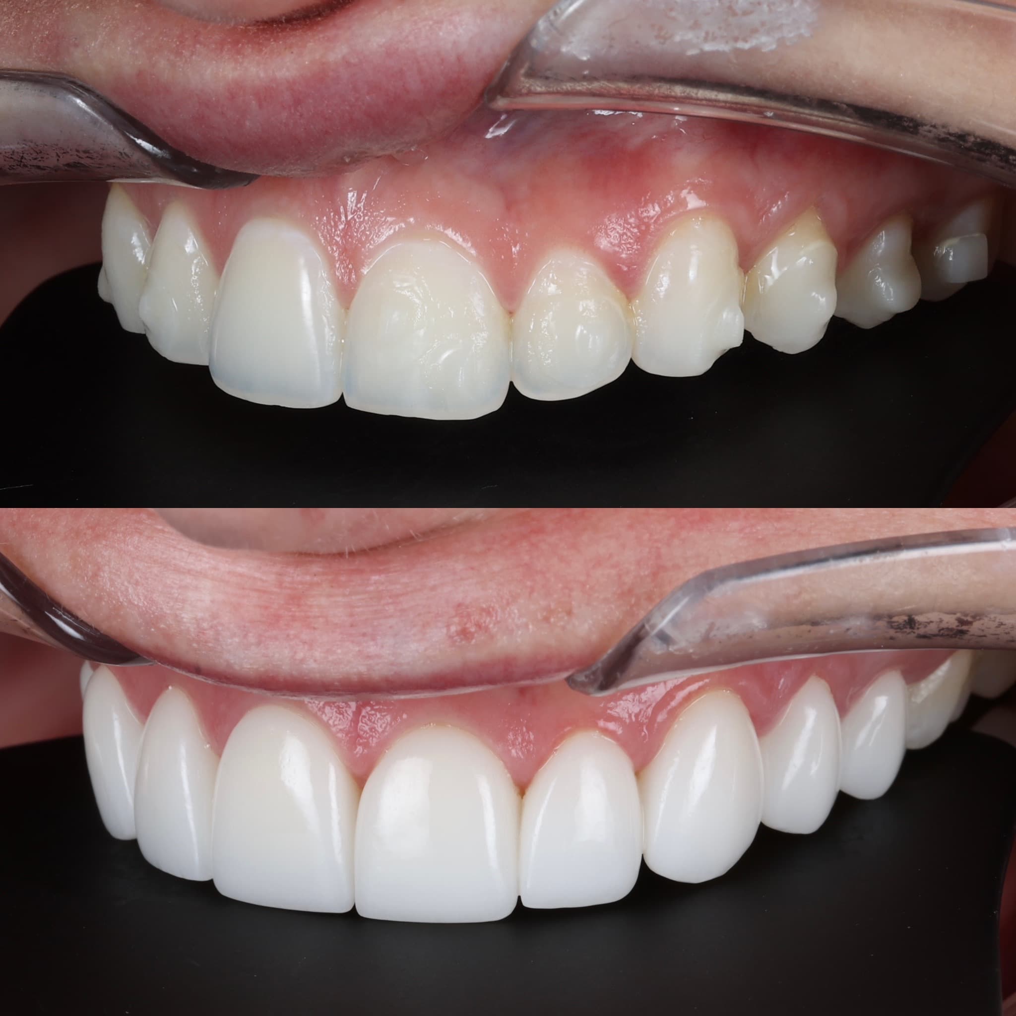 Porcelain veneers before and after