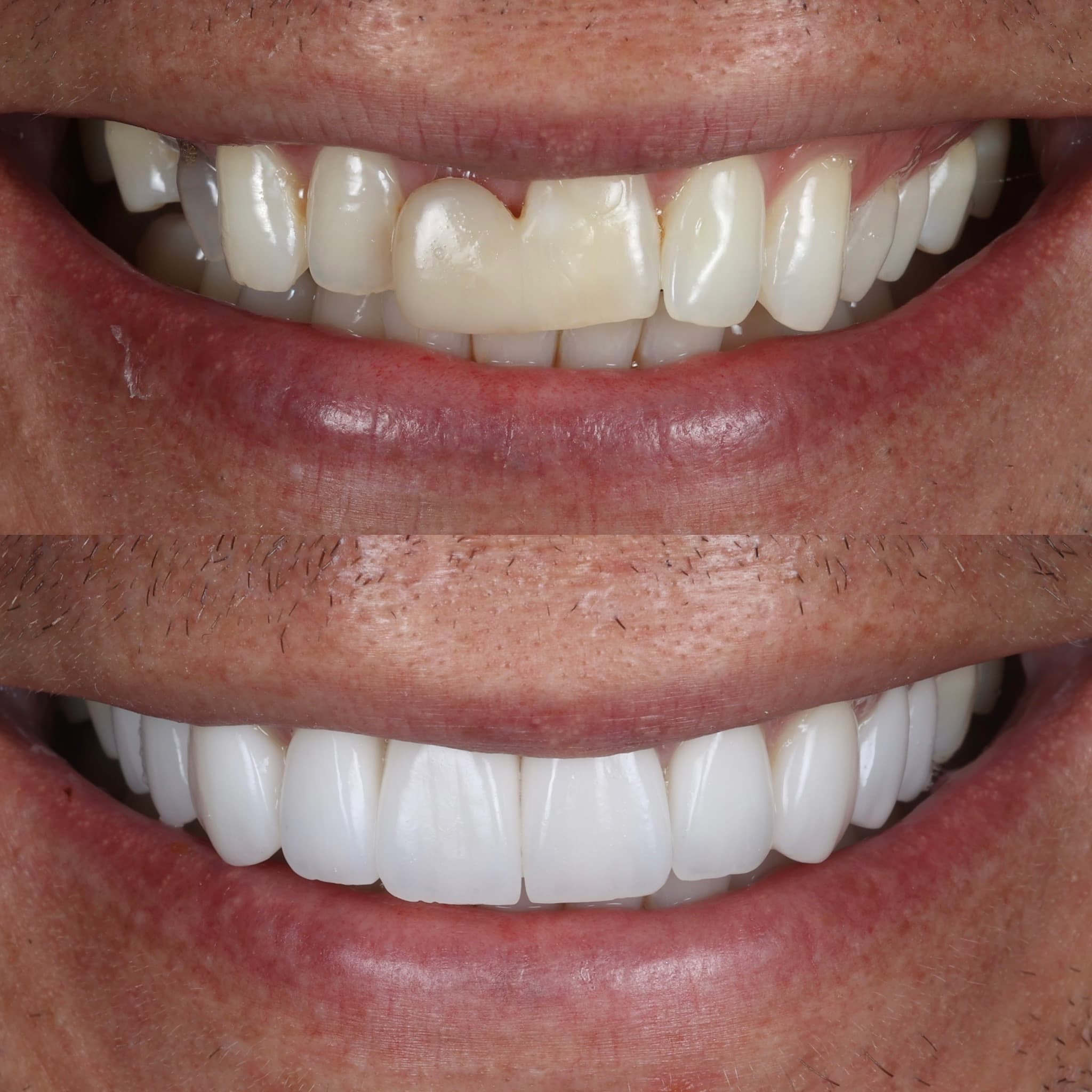 Porcelain veneers before and after