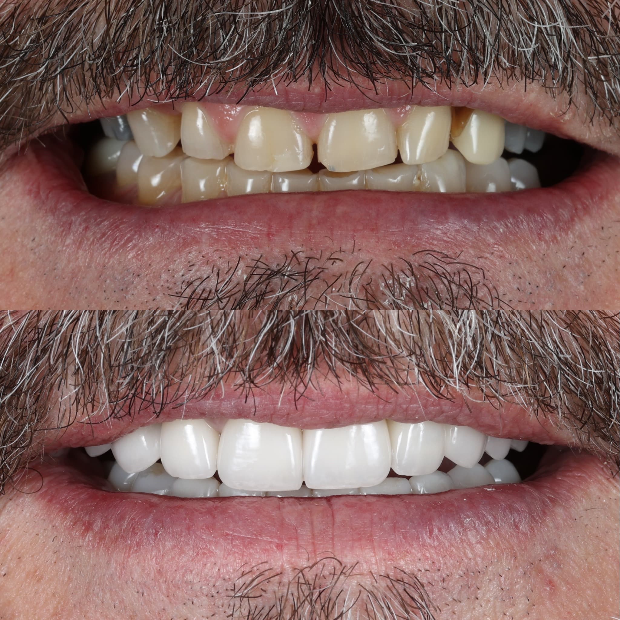 Porcelain veneers before and after