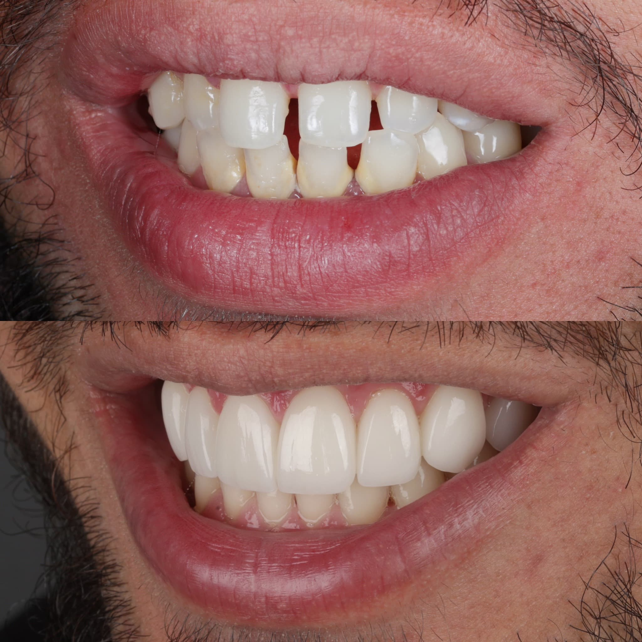 Porcelain veneers before and after