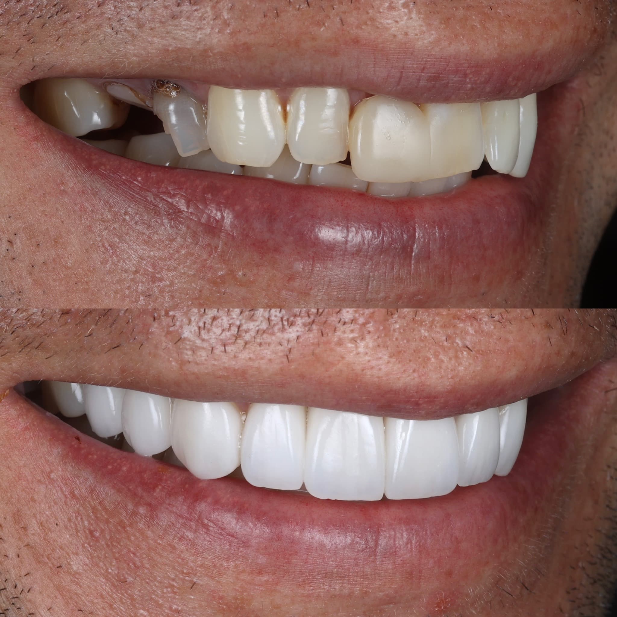 Porcelain veneers before and after