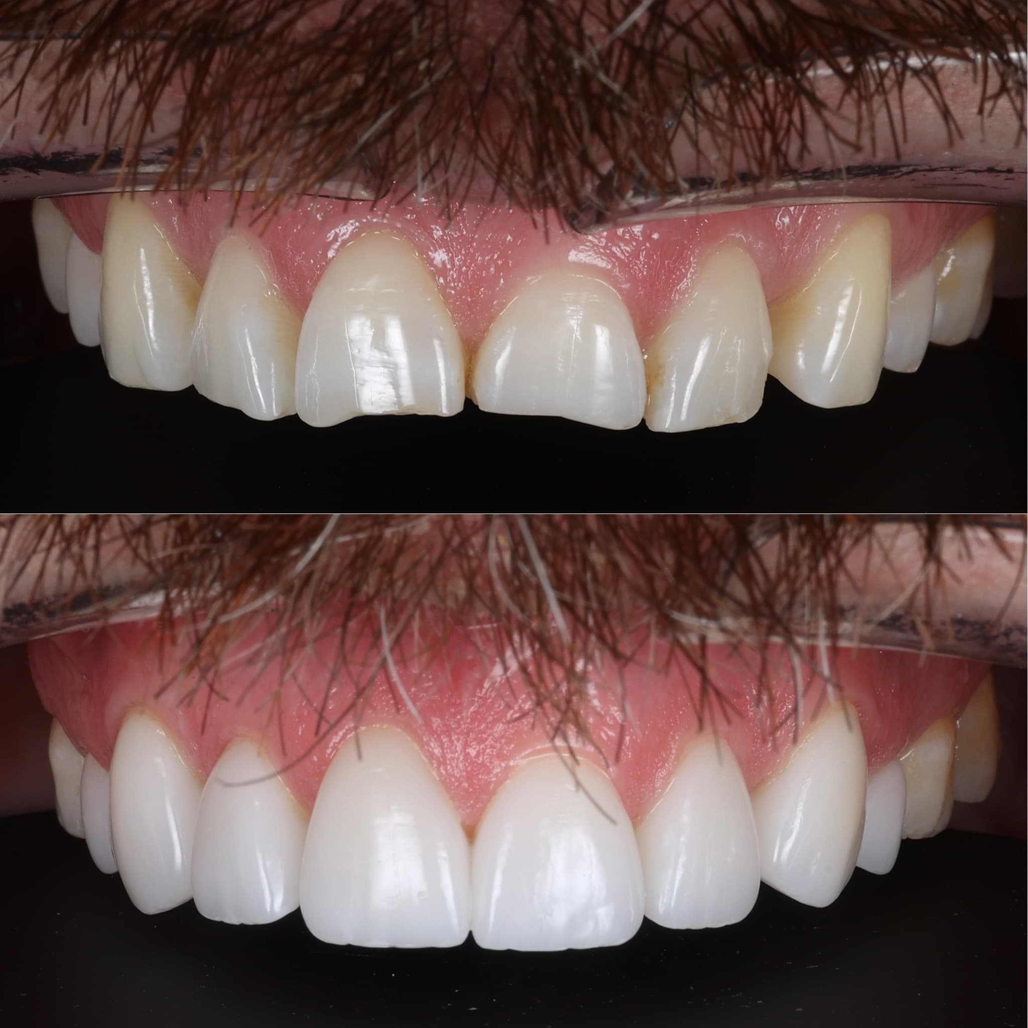 Porcelain veneers before and after