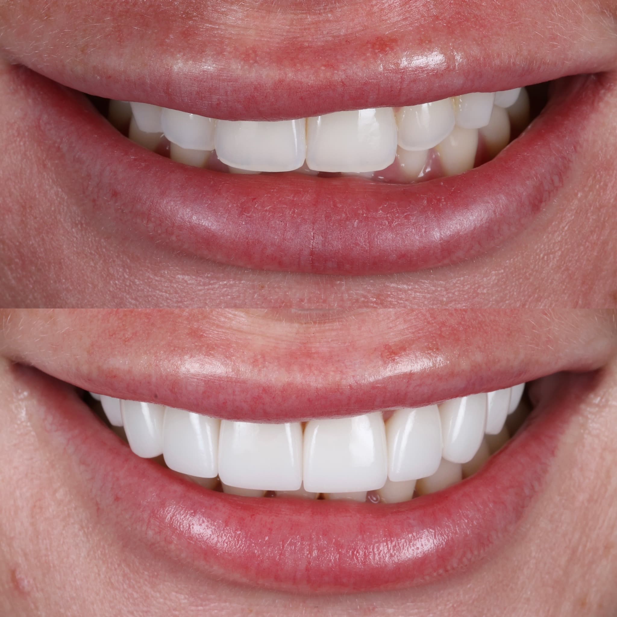 Porcelain veneers before and after