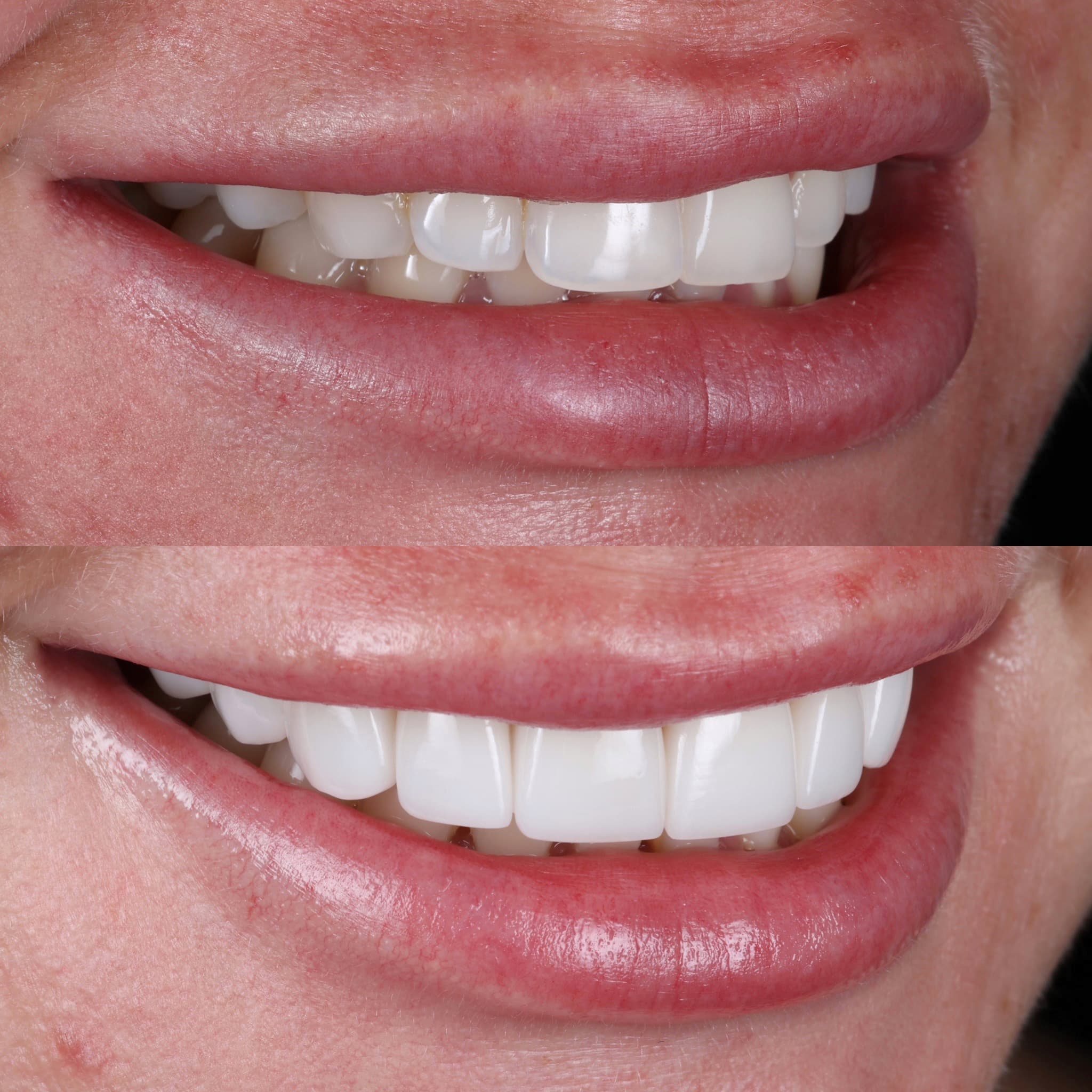 Porcelain veneers before and after