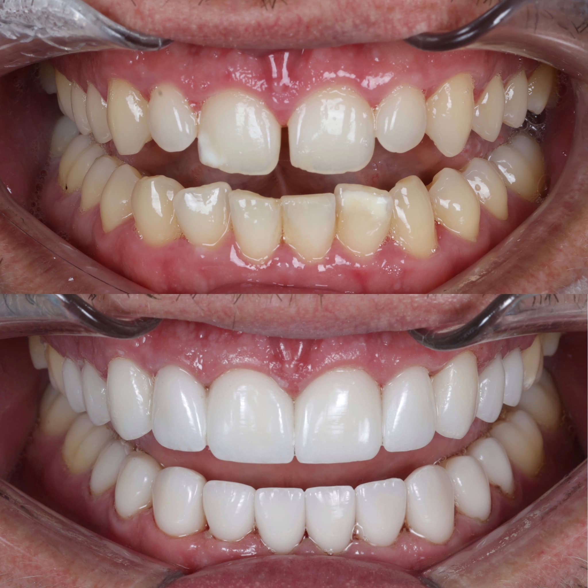Porcelain veneers before and after