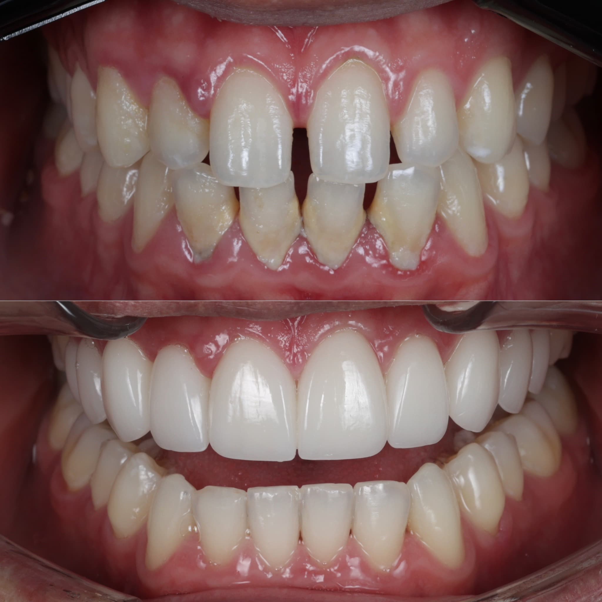 Porcelain veneers before and after