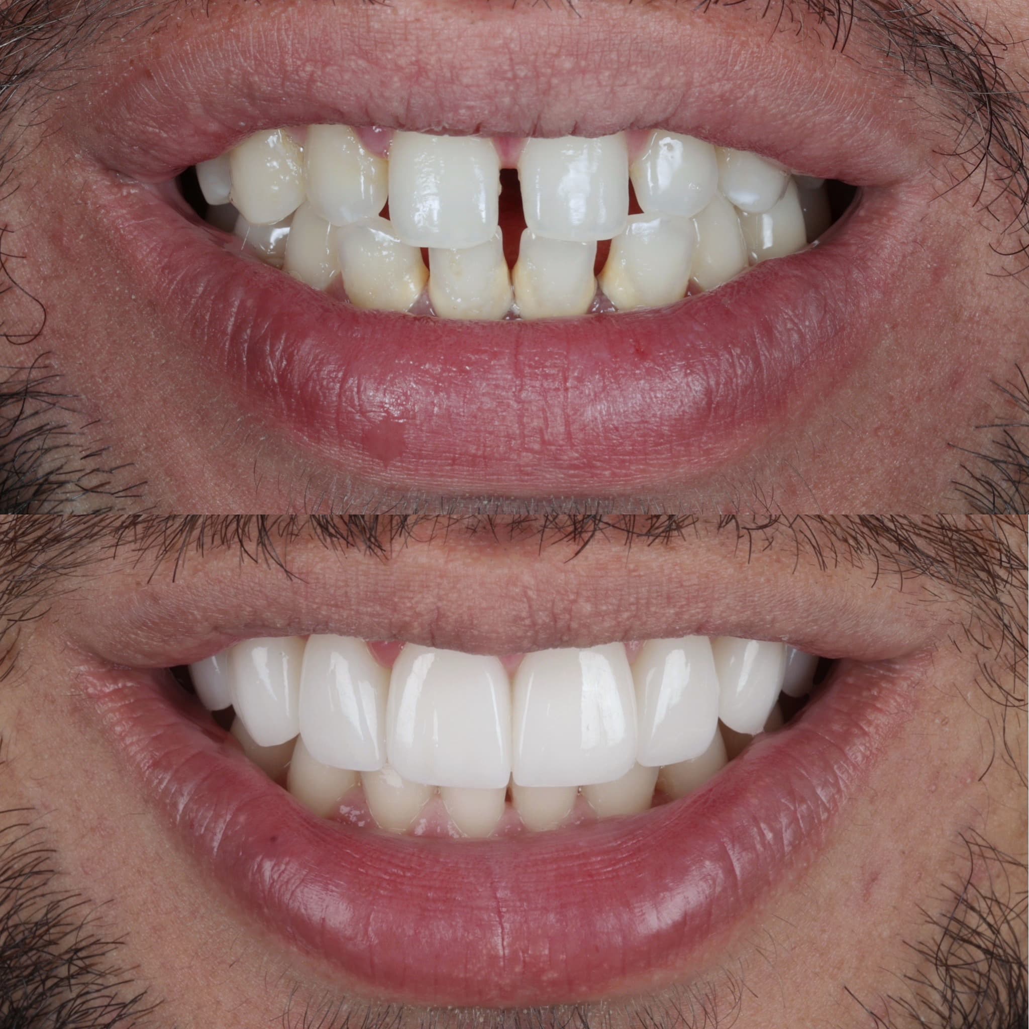 Porcelain veneers before and after