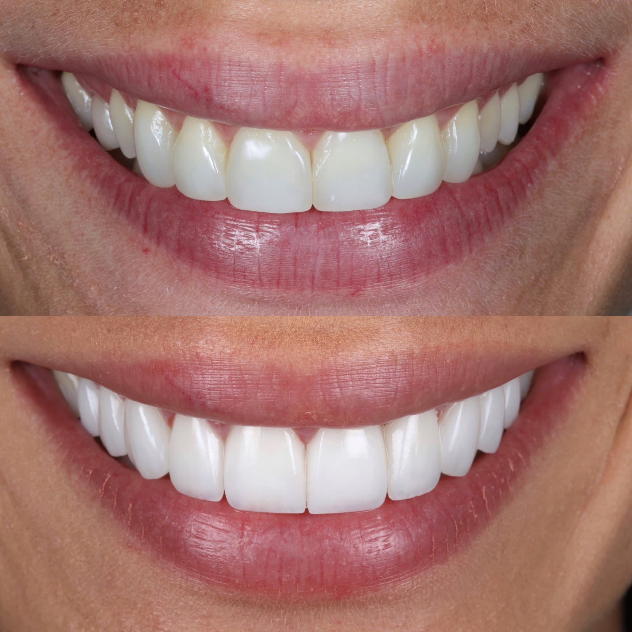 Porcelain veneers before and after