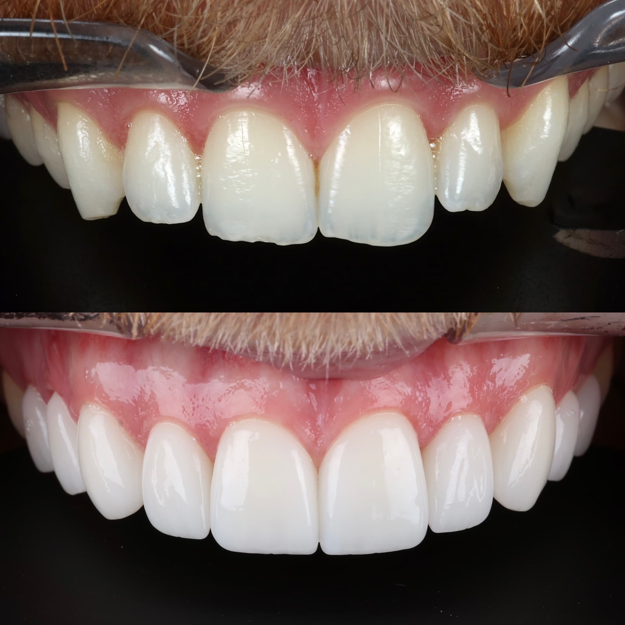 Porcelain veneers before and after