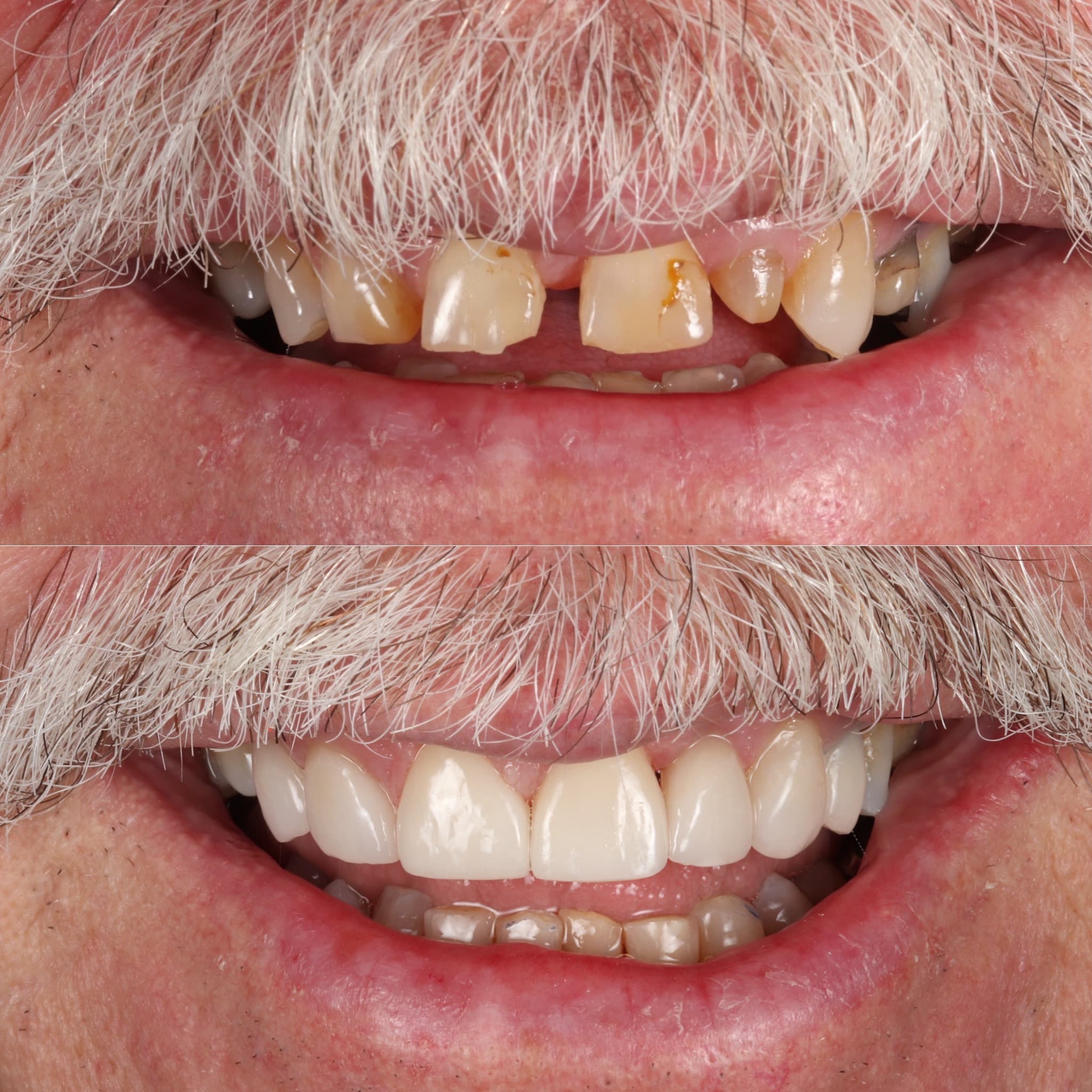 Porcelain veneers before and after