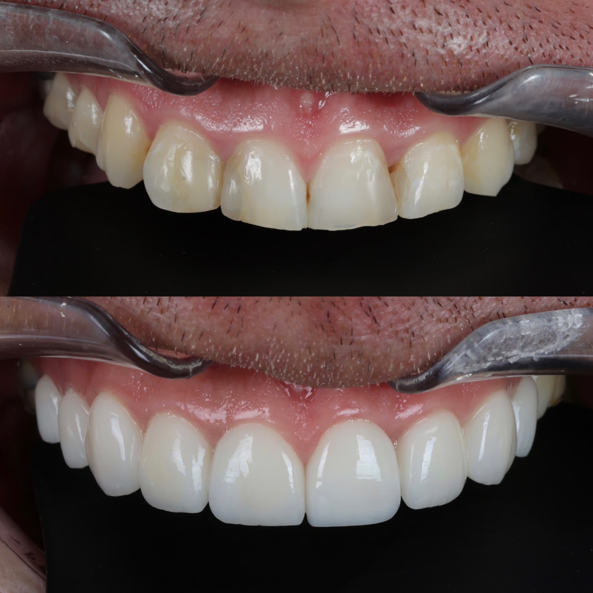 Porcelain veneers before and after